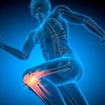 Menisküs Yırtığı Olanlar İçin Önemli Uyarı: Her Durumda Ameliyat Gerekmez!